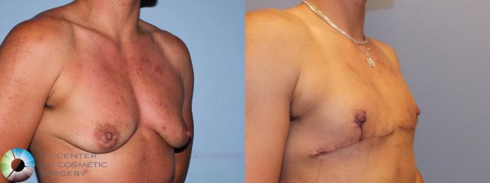 Before & After FTM Top Surgery/Chest Masculinization Case 11434 Right Oblique in Denver and Colorado Springs, CO