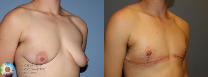 Before & After FTM Top Surgery/Chest Masculinization Case 11435 Right Oblique in Denver, CO