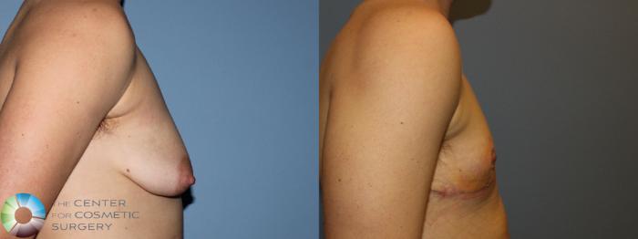 Before & After FTM Top Surgery/Chest Masculinization Case 11435 Right Side in Denver, CO
