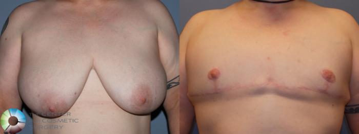 Before & After FTM Top Surgery/Chest Masculinization Case 11436 Front in Denver and Colorado Springs, CO