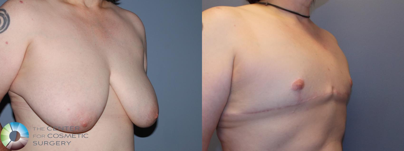 Before & After FTM Top Surgery/Chest Masculinization Case 11436 Right Oblique in Denver and Colorado Springs, CO