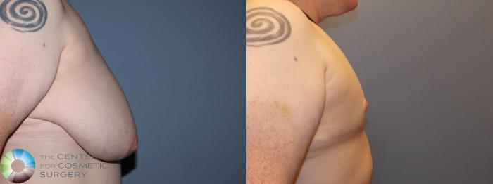 Before & After FTM Top Surgery/Chest Masculinization Case 11436 Right Side in Denver and Colorado Springs, CO
