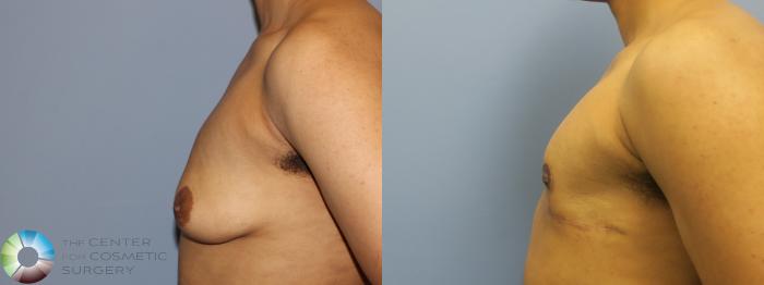 Before & After FTM Top Surgery/Chest Masculinization Case 11439 Left Side in Denver, CO