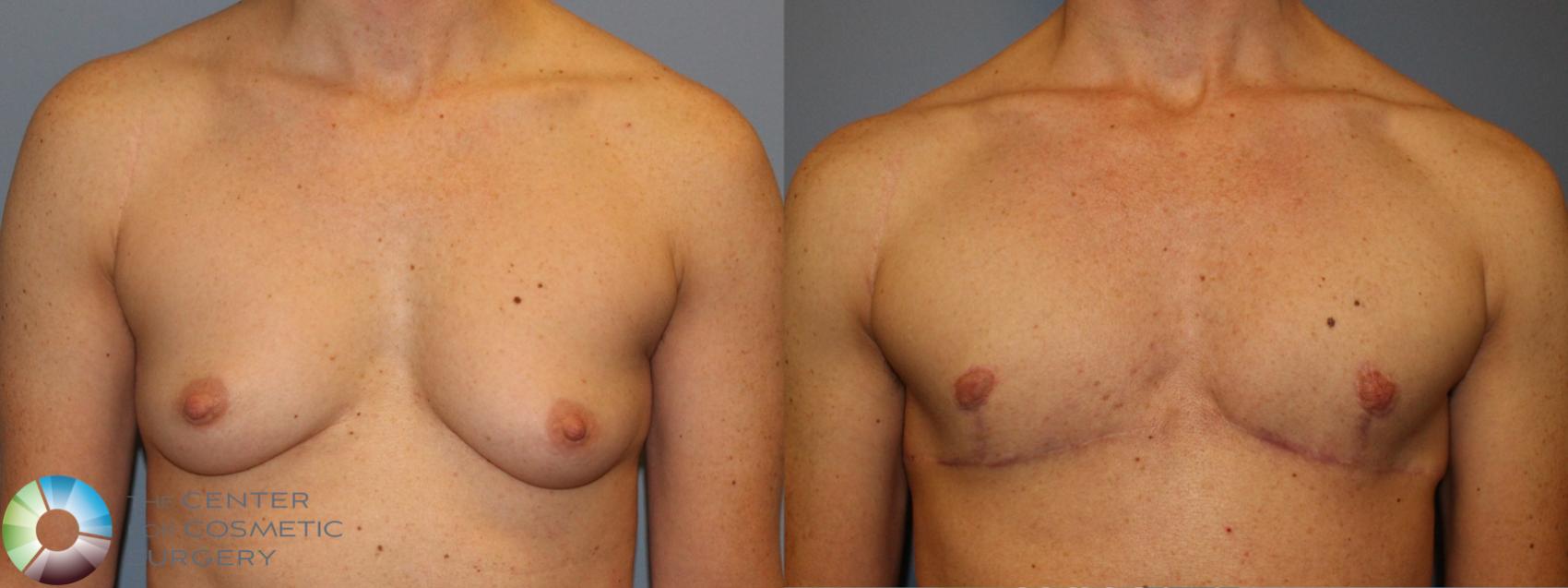 Before & After FTM Top Surgery/Chest Masculinization Case 11440 Front in Denver and Colorado Springs, CO