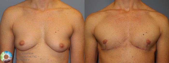 Before & After FTM Top Surgery/Chest Masculinization Case 11440 Front in Denver, CO
