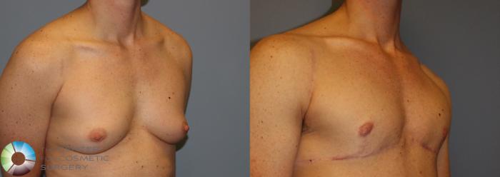Before & After FTM Top Surgery/Chest Masculinization Case 11440 Right Oblique in Denver, CO