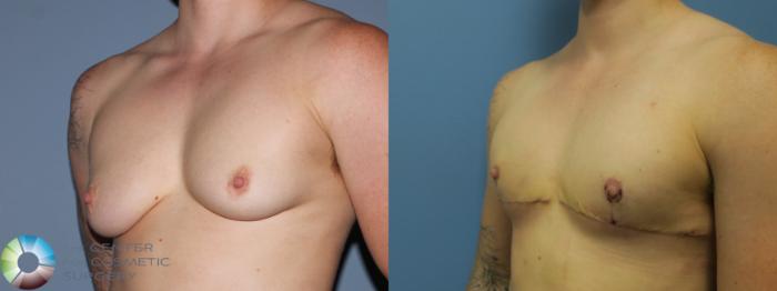 Before & After FTM Top Surgery/Chest Masculinization Case 11442 Left Oblique in Denver and Colorado Springs, CO