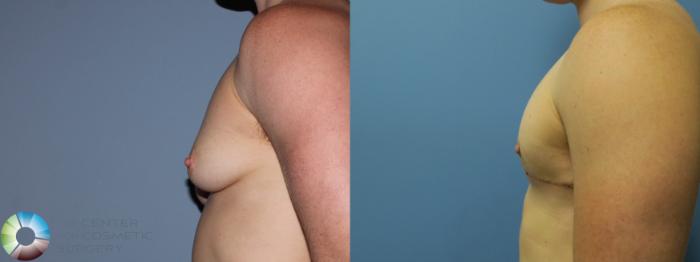 Before & After FTM Top Surgery/Chest Masculinization Case 11442 Left Side in Denver and Colorado Springs, CO