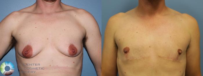 Before & After FTM Top Surgery/Chest Masculinization Case 11468 Front in Denver, CO