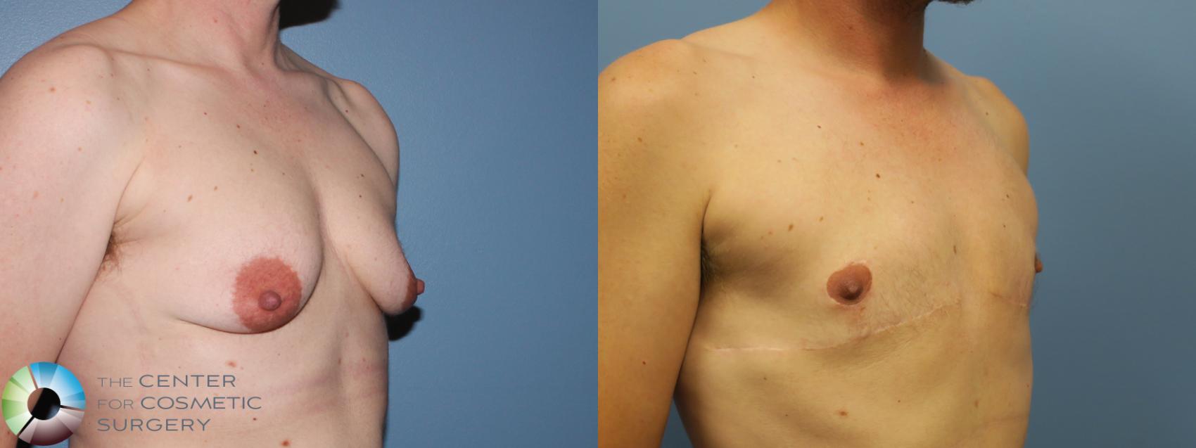 Before & After FTM Top Surgery/Chest Masculinization Case 11468 Right Oblique in Denver, CO