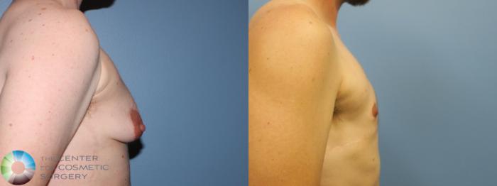 Before & After FTM Top Surgery/Chest Masculinization Case 11468 Right Side in Denver, CO