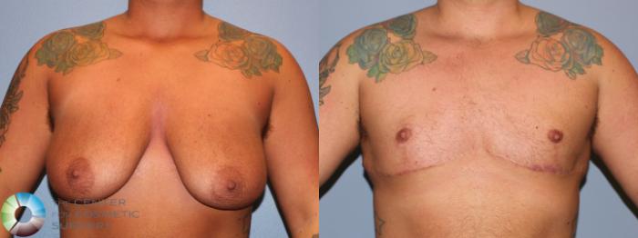 Before & After FTM Top Surgery/Chest Masculinization Case 11470 Front in Denver and Colorado Springs, CO