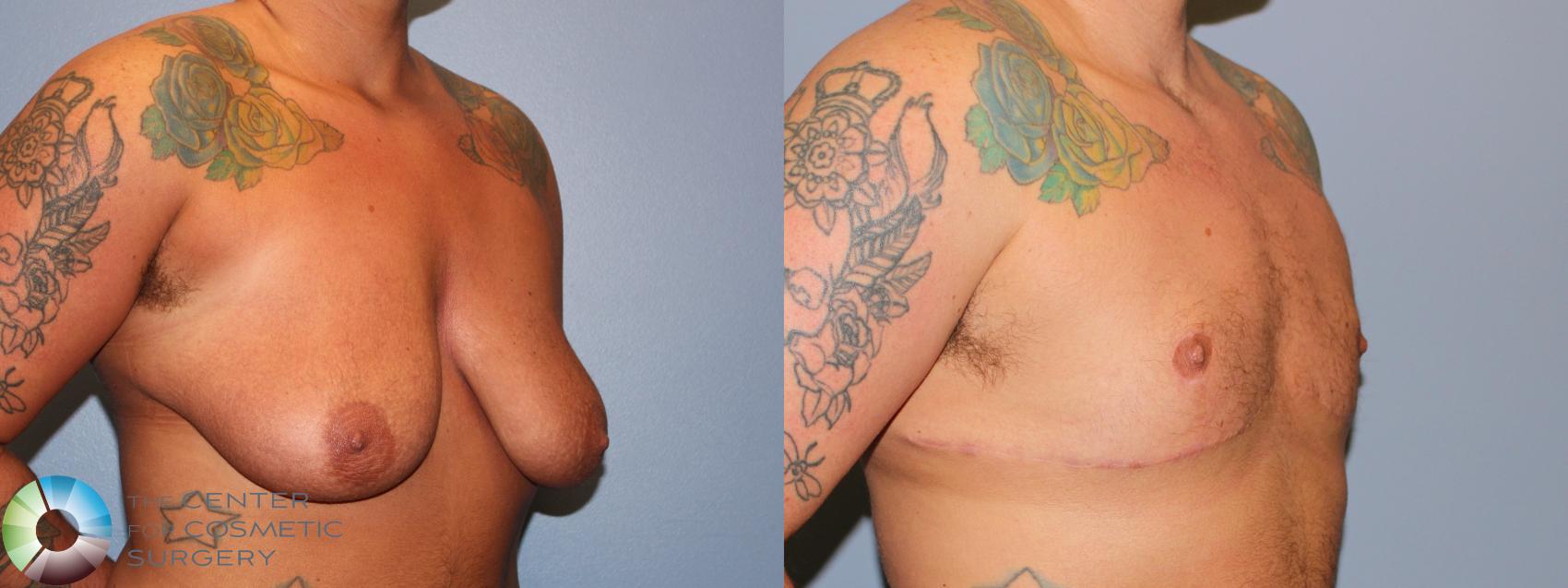 Before & After FTM Top Surgery/Chest Masculinization Case 11470 Right Oblique in Denver and Colorado Springs, CO