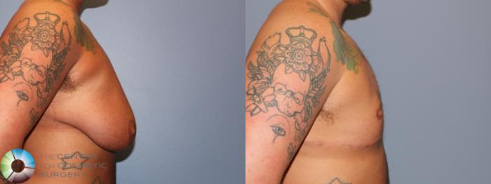Before & After FTM Top Surgery/Chest Masculinization Case 11470 Right Side in Denver and Colorado Springs, CO