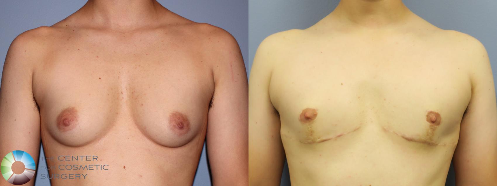 Before & After FTM Top Surgery/Chest Masculinization Case 11471 Front in Denver and Colorado Springs, CO