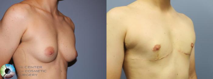 Before & After FTM Top Surgery/Chest Masculinization Case 11471 Right Oblique in Denver and Colorado Springs, CO