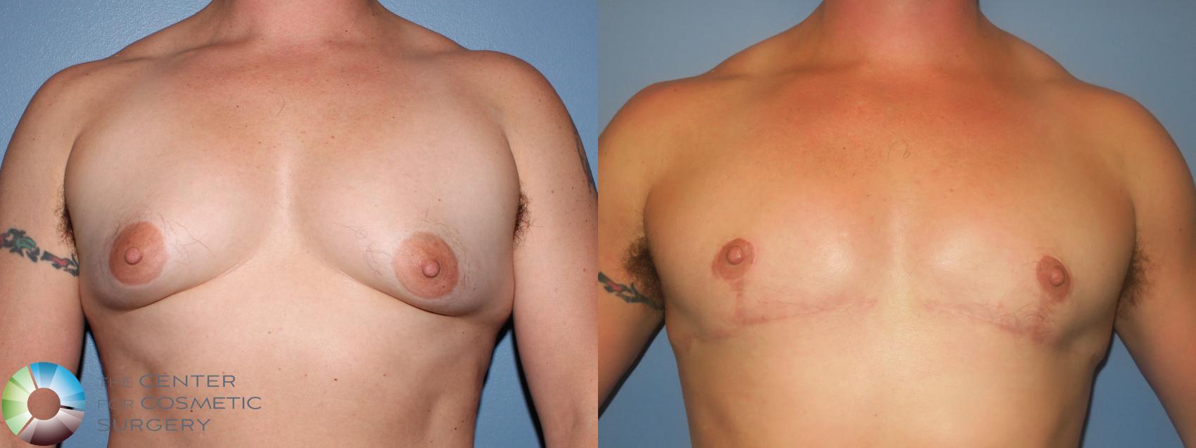 Before & After FTM Top Surgery/Chest Masculinization Case 11474 Front in Denver, CO