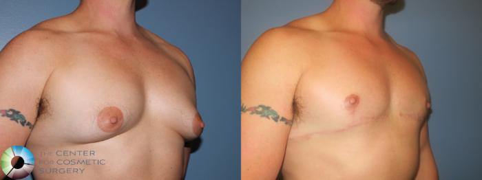 Before & After FTM Top Surgery/Chest Masculinization Case 11474 Right Oblique in Denver, CO