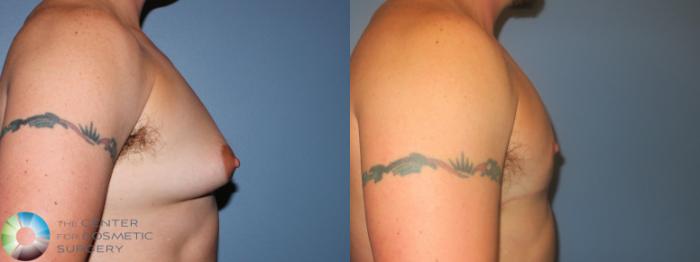 Before & After FTM Top Surgery/Chest Masculinization Case 11474 Right Side in Denver, CO