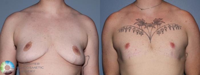 Before & After FTM Top Surgery/Chest Masculinization Case 11475 Front in Denver and Colorado Springs, CO