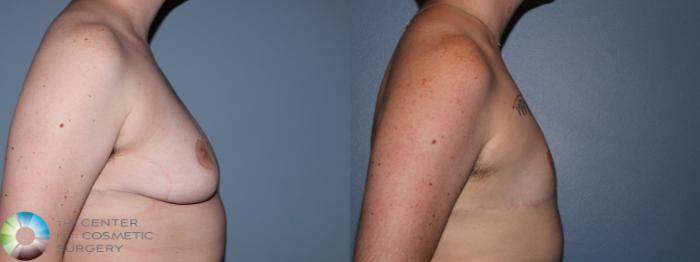 Before & After FTM Top Surgery/Chest Masculinization Case 11475 Right Side in Denver and Colorado Springs, CO