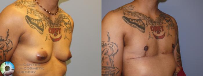 Before & After FTM Top Surgery/Chest Masculinization Case 11476 Right Oblique in Denver and Colorado Springs, CO