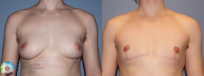 Before & After FTM Top Surgery/Chest Masculinization Case 11477 Front in Denver and Colorado Springs, CO