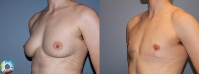 Before & After FTM Top Surgery/Chest Masculinization Case 11477 Left Oblique in Denver and Colorado Springs, CO