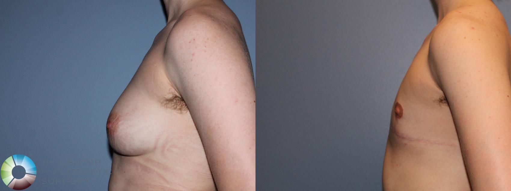 Before & After FTM Top Surgery/Chest Masculinization Case 11477 Left Side in Denver and Colorado Springs, CO