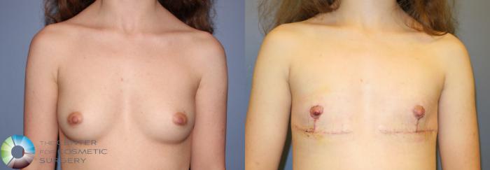 Before & After FTM Top Surgery/Chest Masculinization Case 11479 Front in Denver and Colorado Springs, CO