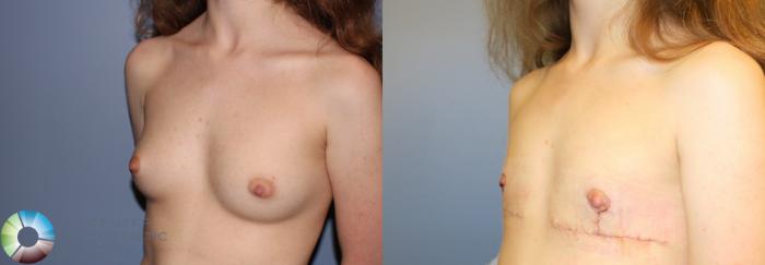 Before & After FTM Top Surgery/Chest Masculinization Case 11479 Left Oblique in Denver and Colorado Springs, CO