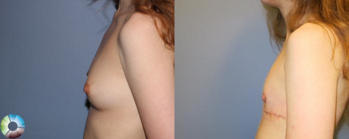 Before & After FTM Top Surgery/Chest Masculinization Case 11479 Left Side in Denver and Colorado Springs, CO
