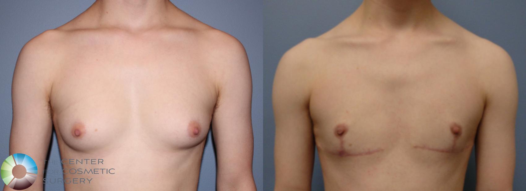Before & After FTM Top Surgery/Chest Masculinization Case 11480 Front in Denver and Colorado Springs, CO
