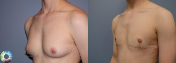 Before & After FTM Top Surgery/Chest Masculinization Case 11480 Left Oblique in Denver and Colorado Springs, CO