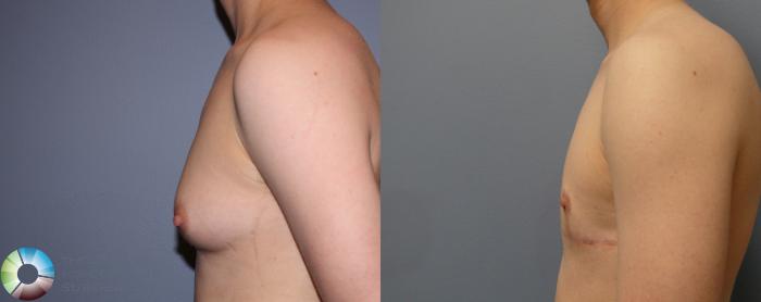 Before & After FTM Top Surgery/Chest Masculinization Case 11480 Left Side in Denver and Colorado Springs, CO