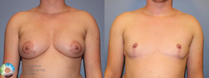 Before & After FTM Top Surgery/Chest Masculinization Case 11483 Front in Denver and Colorado Springs, CO