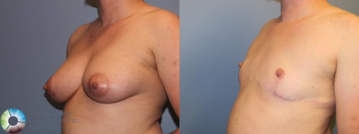 Before & After FTM Top Surgery/Chest Masculinization Case 11483 Left Oblique in Denver and Colorado Springs, CO