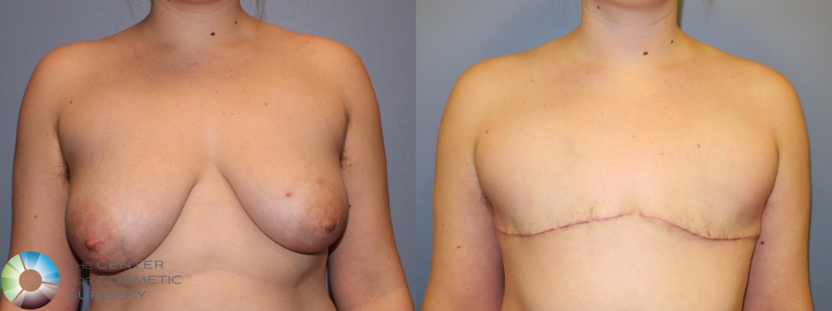 Before & After FTM Top Surgery/Chest Masculinization Case 11484 Front in Denver and Colorado Springs, CO
