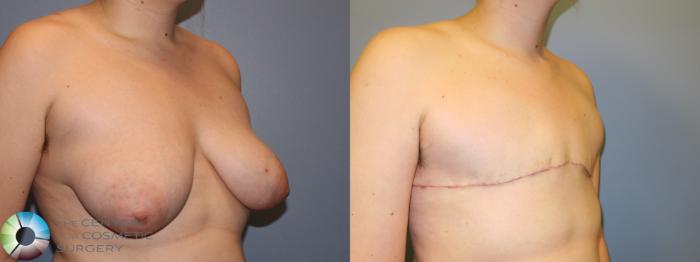 Before & After FTM Top Surgery/Chest Masculinization Case 11484 Right Oblique in Denver and Colorado Springs, CO