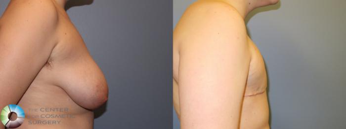 Before & After FTM Top Surgery/Chest Masculinization Case 11484 Right Side in Denver and Colorado Springs, CO