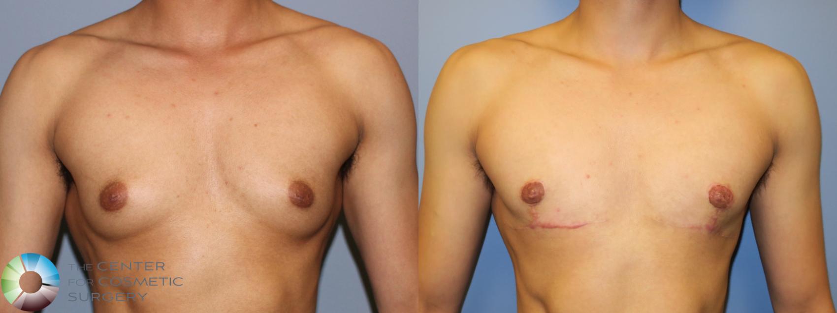Before & After FTM Top Surgery/Chest Masculinization Case 11525 Front in Denver and Colorado Springs, CO