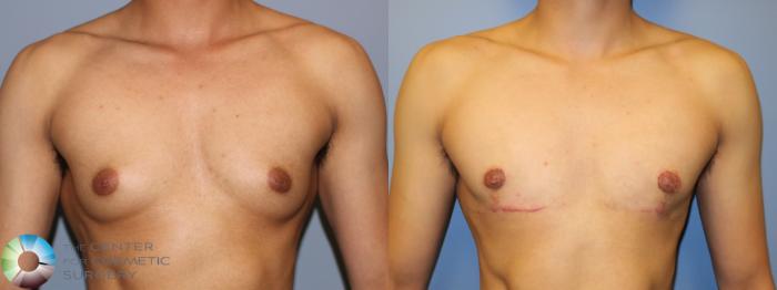 Before & After FTM Top Surgery/Chest Masculinization Case 11525 Front in Denver and Colorado Springs, CO