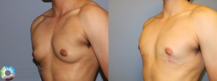 Before & After FTM Top Surgery/Chest Masculinization Case 11525 Left Oblique in Denver and Colorado Springs, CO
