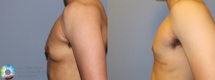 Before & After FTM Top Surgery/Chest Masculinization Case 11525 Left Side in Denver and Colorado Springs, CO