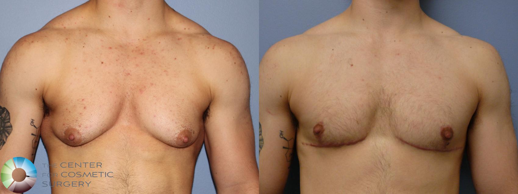 Before & After FTM Top Surgery/Chest Masculinization Case 11541 Front in Denver and Colorado Springs, CO