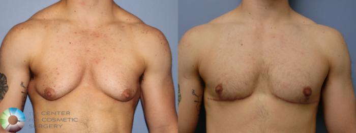 Before & After FTM Top Surgery/Chest Masculinization Case 11541 Front in Denver, CO