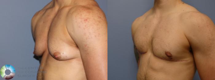 Before & After FTM Top Surgery/Chest Masculinization Case 11541 Left Oblique in Denver, CO