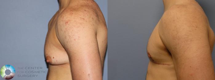 Before & After FTM Top Surgery/Chest Masculinization Case 11541 Left Side in Denver, CO