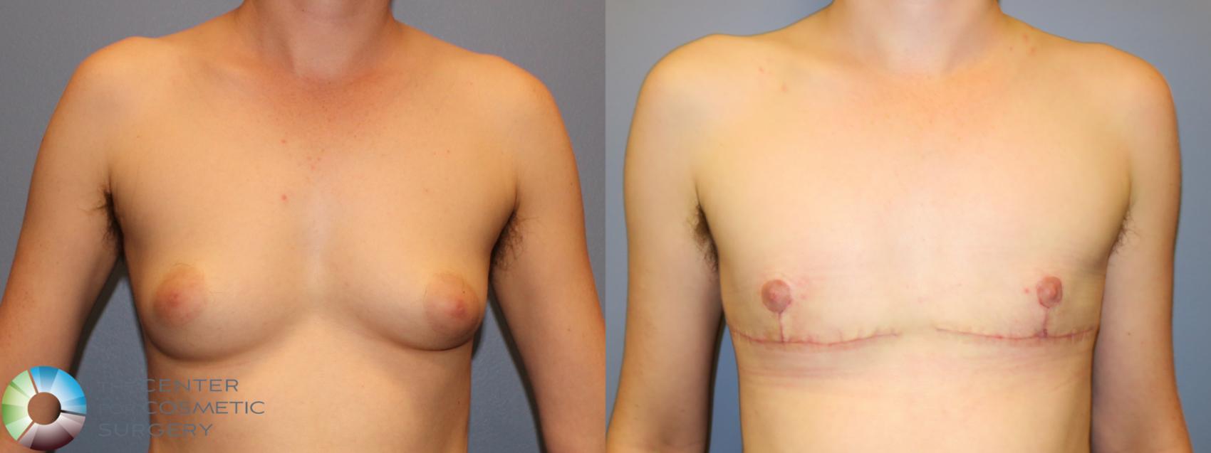 Before & After FTM Top Surgery/Chest Masculinization Case 11542 Front in Denver and Colorado Springs, CO