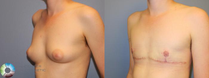 Before & After FTM Top Surgery/Chest Masculinization Case 11542 Left Oblique in Denver and Colorado Springs, CO